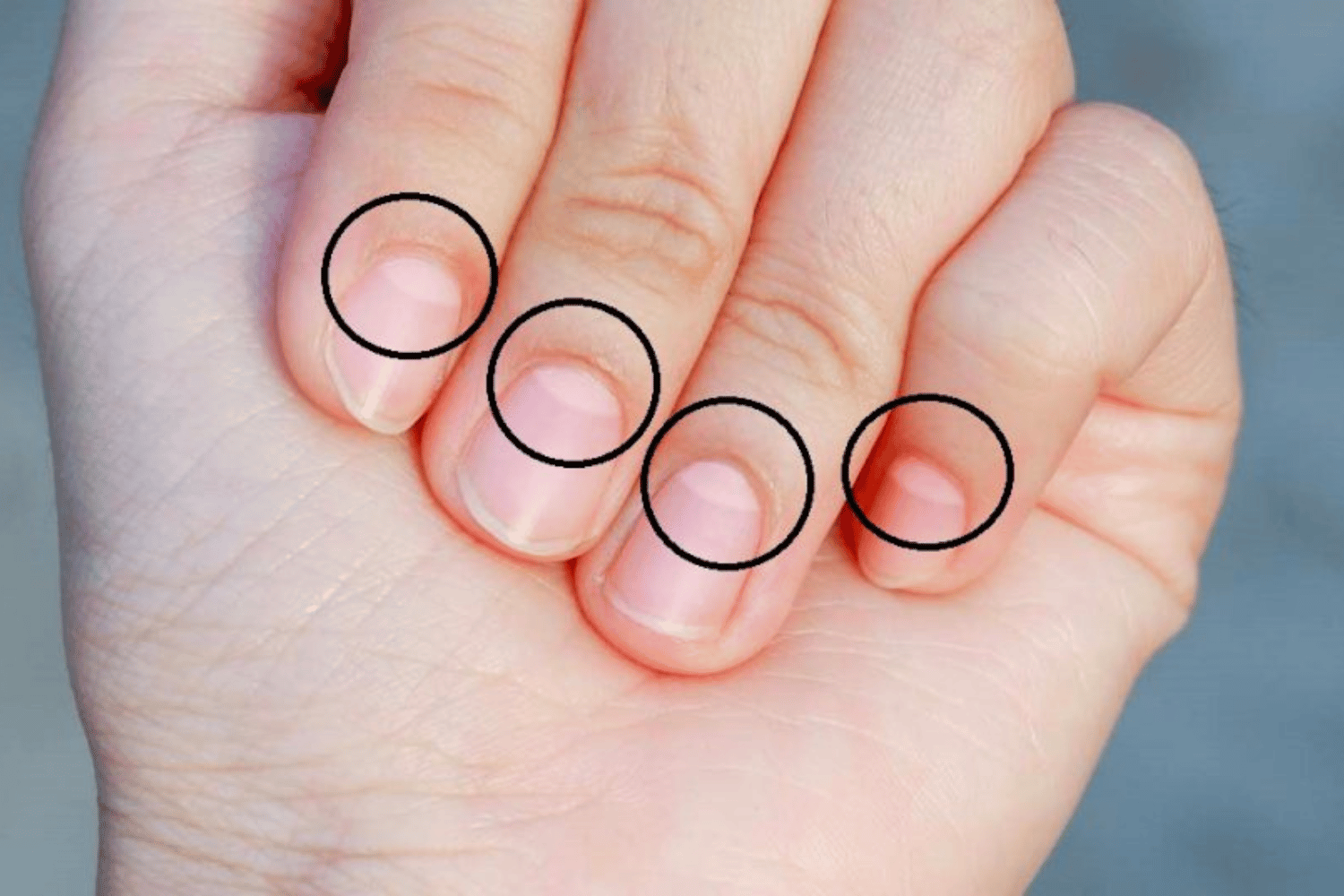 No Moons on Your Fingernails? Here’s What It Could Say About Your Health